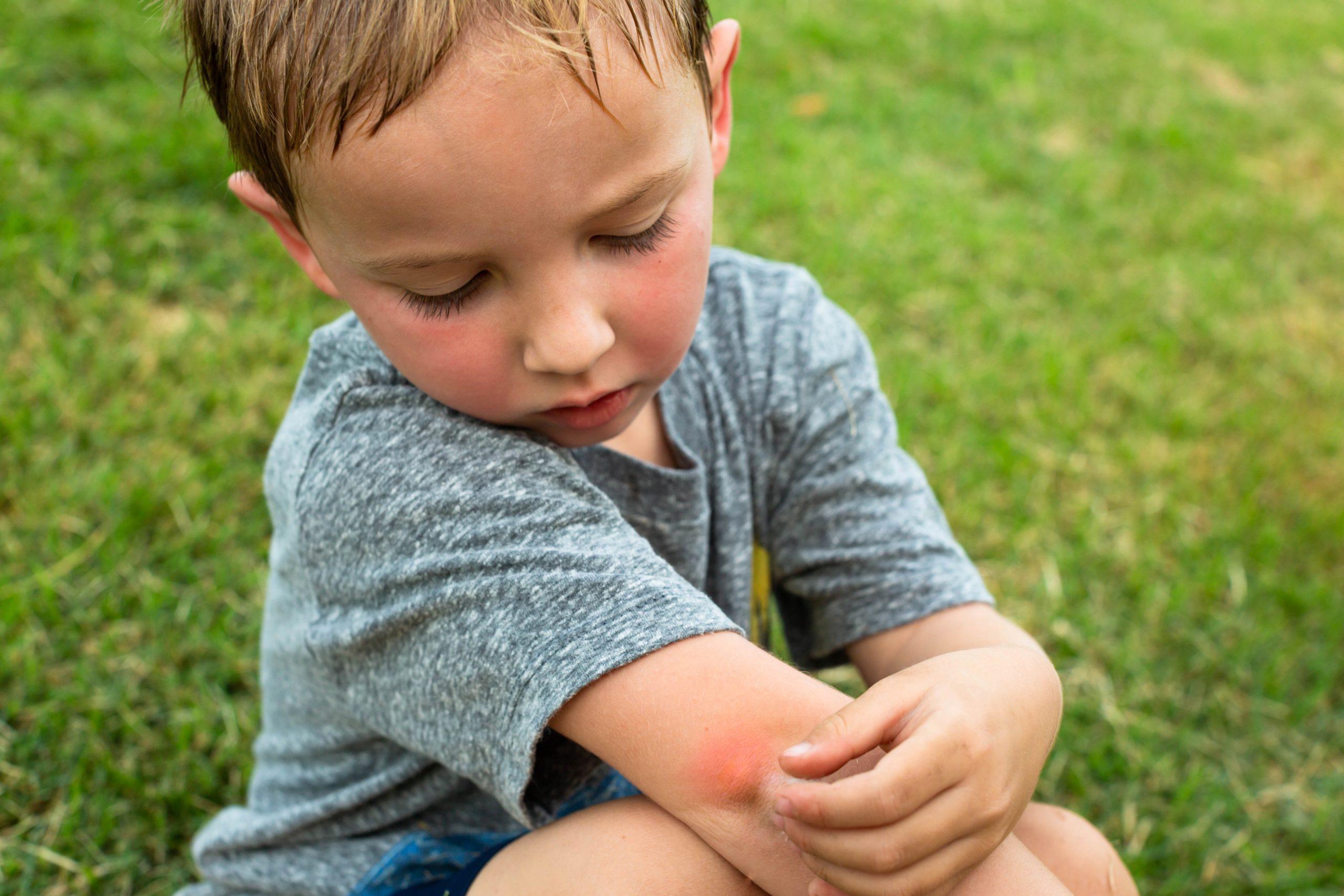 A little boy scratching his arm from a red mosquito bite after playing outdoor in the tropical summer time.